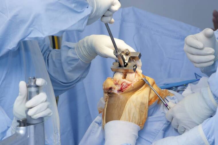 belauneko artrosiaren kirurgia