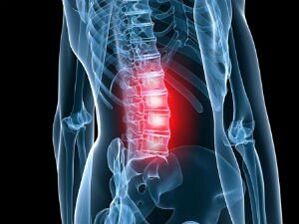Lumbar bizkarrezurraren osteokondrosia