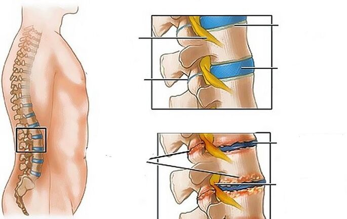 Lumbar eskualdeko osteokondrosia