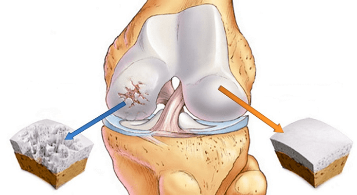 kartilago osasuntsua eta artrosiak eragindako kartilagoak