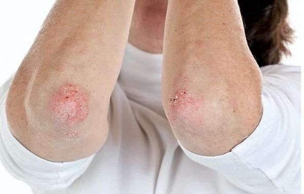 Psoriasia duten pertsonak artritis psoriasikoa jasaten dute