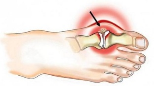 artritisaren eta artrosiaren arteko desberdintasun nagusiak
